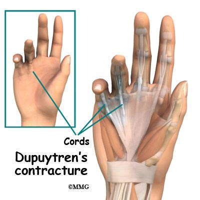 EOrthopod Dupuytren S Contracture Dupuytren S Contracture Surgery