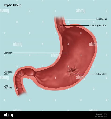 Duodenal ulcers fotografías e imágenes de alta resolución Alamy