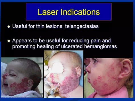 Infantile Hemangioma Ppt