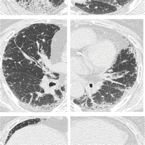 Chest Computed Tomography On First Admission Download Scientific Diagram