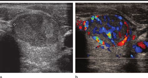 Role Of Color Doppler Us A Transverse Gray Scale Image Of Download Scientific Diagram