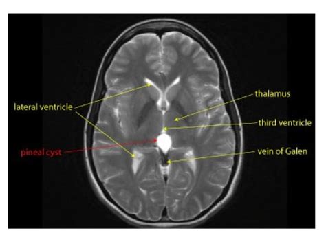 Diagnostic Imaging Of Pineal Region Masses PPT