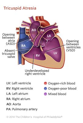 Tricuspid Atresia | Children's Hospital of Philadelphia