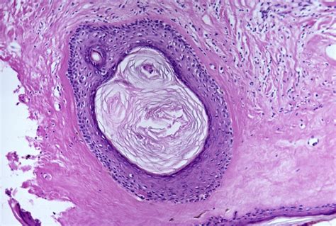 Treatment of vulvar lichen sclerosus - The Clinical Advisor