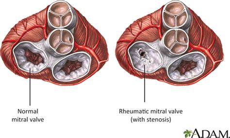 Prevention Of Acute Rheumatic Fever And Rheumatic Heart Disease Circulation