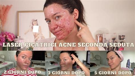 LASER CICATRICI ACNE COSA ASPETTARSI DOPO IL PRIMO TRATTAMENTO