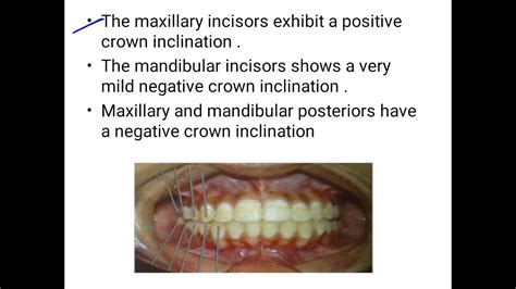 Andrews Six Keys To Normal Occlusion YouTube