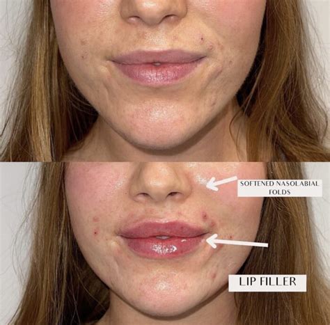 Nasolabial Fold Fillers One Cosmetic