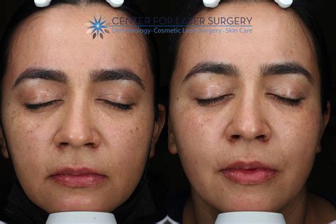 Intense Pulsed Light Ipl Washington Dc Center For Laser Surgery