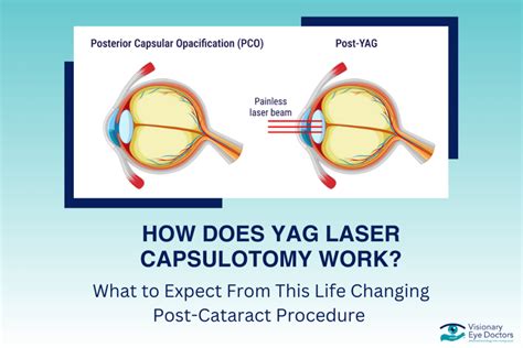 Can Cataracts Come Back Learn About Secondary Cataracts And Treatment