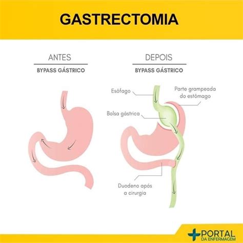 Gastrectomia Enfermagemporamor Enfermagemaartedecuidar Enfermagem