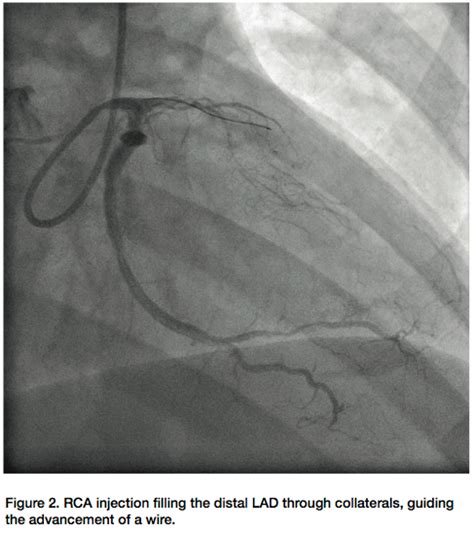 Transradial Revascularization Of A Chronic Total Left Anterior