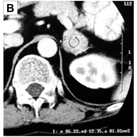 left adrenal adenoma. Notes: (A) cT attenuation value of 28 hU on... | Download Scientific Diagram