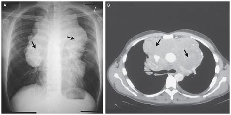 Mediastinal Lymphadenopathy