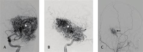 Digital Substraction Angiography Dsa Anteroposterior A And Lateral Download Scientific