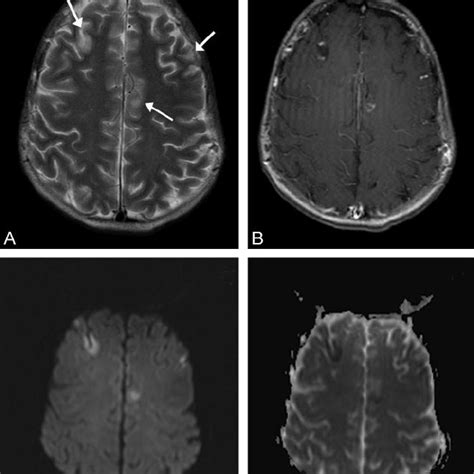 A Axial T2 Weighted Tse 4000 99 [tr Te] Image Shows A Large Vermian