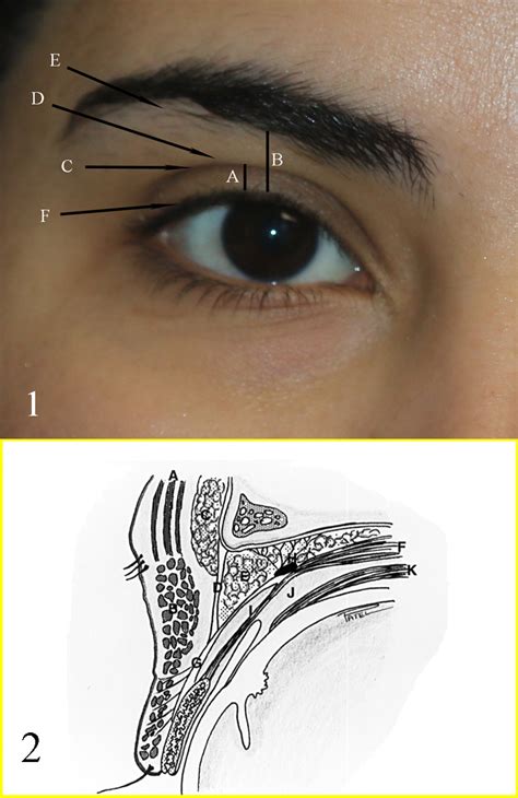 Figure Fig 1 A Upper Eyelid Statpearls Ncbi Bookshelf