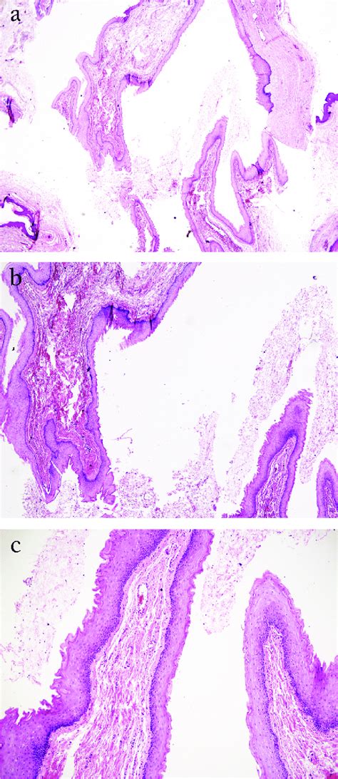 Histopathologic Examination Revealed A Non Neoplastic Lesion Depicting