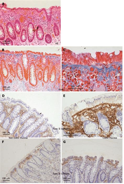 Expression of collagen type Ⅲ and Ⅳ in colonic mucosa of collagenous