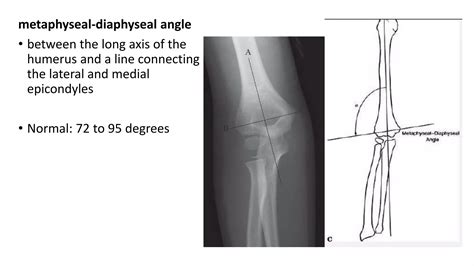 Cubitus valgus varus | PPT