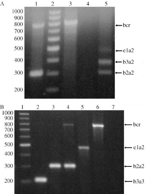 A Agarose Gel Electrophoresis Of Multiplex Pcr Products In Patient