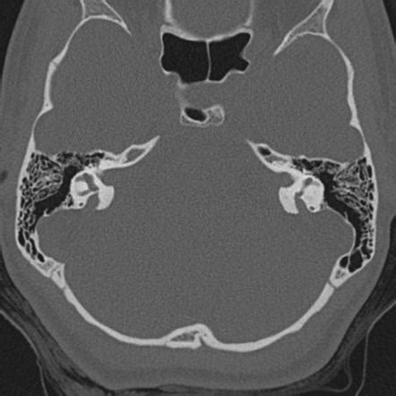 Vestibular Aqueduct