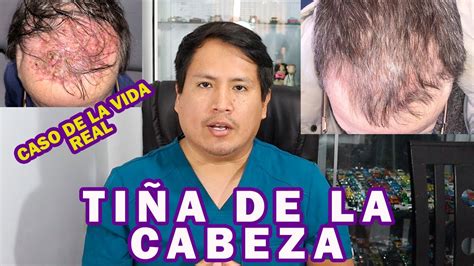 Como Eliminar La TiÑa De La Cabeza Youtube