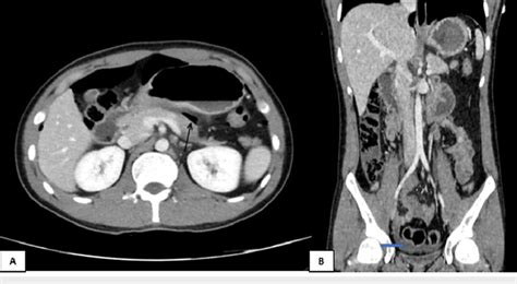 Ct Abdomen With Iv Contrast A Axial And B Coronal Reformatted