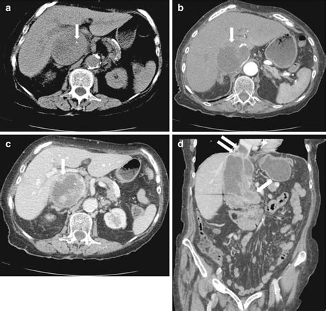 Retroperitoneum Radiology Key