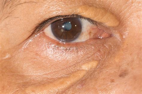 Xanthelasma Removal: Get Rid of Cholesterol Deposits | Reader's Digest