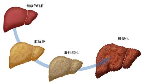 脂肪肝不是肥胖那么简单 它会让你得肝癌！ 疾病百科 佳礼资讯网