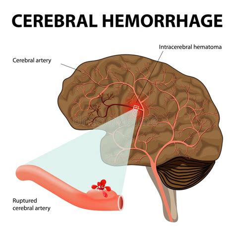 Cerebral Hemorrhage Stock Vector Illustration Of Healthcare 44474853