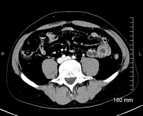 Retroaortic Left Renal Vein Type I Image