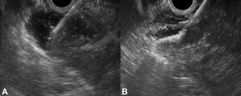 Novel Eus Guided Gastrojejunostomy Technique Using A New Double Balloon