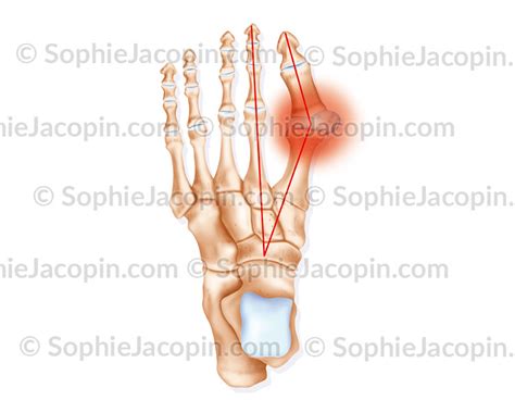 HALLUX VALGUS Illustration Medicale Sophie Jacopin