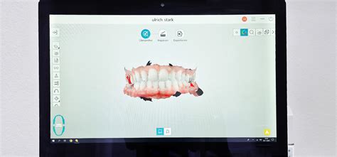 Intraoral Scanner Digitaler Abdruck Zahnarzt Fulda Dr Stark