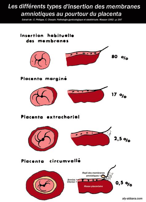 Types Of Placental Abnormalities