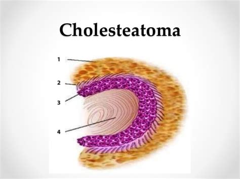 Cholesteatoma