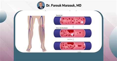 chronic venous insufficiency farouk marzouk md