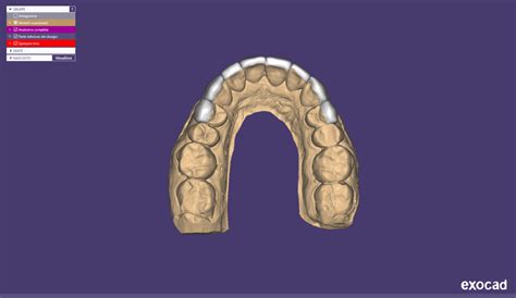 Carillas dentales ultrafinas Lumineers la mejor opción para conseguir