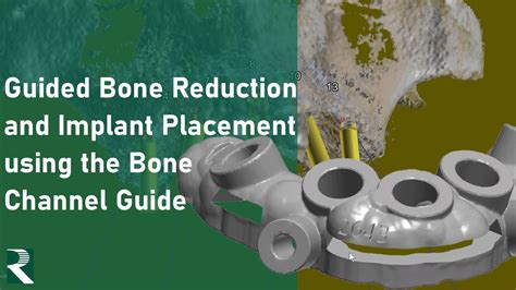 Guided Bone Reduction And Implant Placement Using The Bone Channel