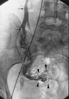 Ovarian Vein Embolization For The Treatment Of Pelvic Congestion