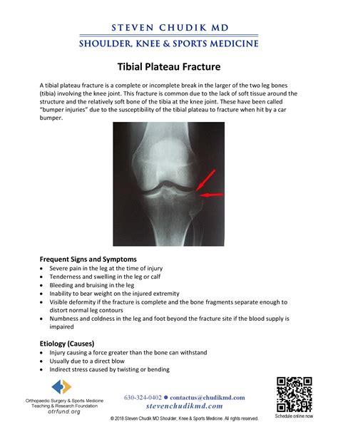 Tibial Plateau Fracture Causes Symptoms And Treatment 54 Off