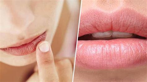 Cura Tus Labios Quemados Con Estos 7 Remedios Naturales