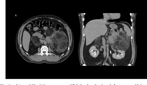 Figure 1 From Congenital Adrenal Hyperplasia With Associated Giant