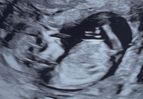 12 Week Scan Gender Guesses Mumsnet