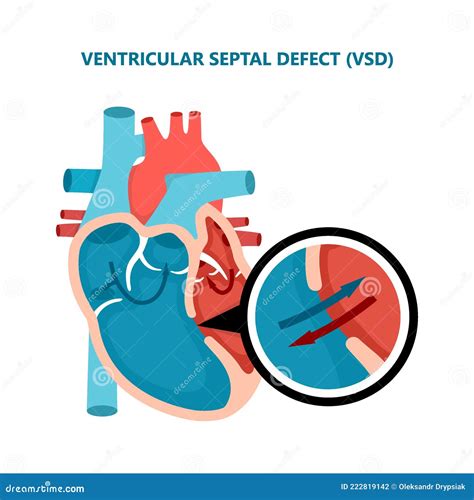 Ventricular Septal Defect Vsd Human Heart Muscle Diseases Cross