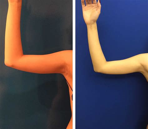 Before & After: Mini Arm Lift | Neinstein Plastic Surgery