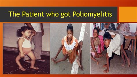 Poliomyelitis презентация онлайн