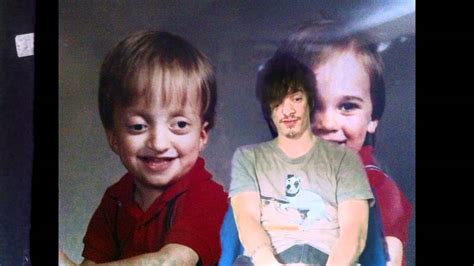 A Crouzon Syndrome Documentary: The eyes - YouTube
